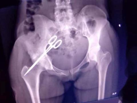 Xray film of patient